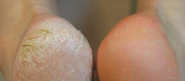 Plástica dos pés na UnaEssential